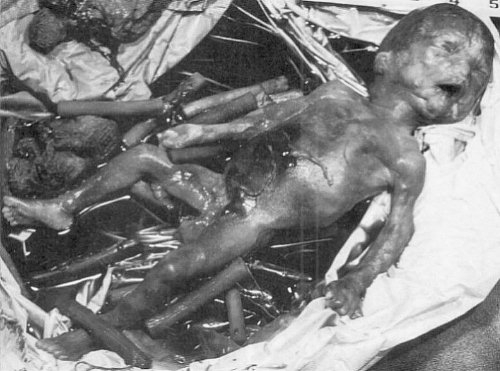 aborted human fetus. Aborted Fetus Organs,